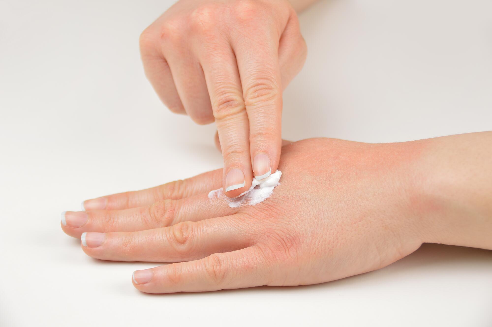 Lenire una riacutizzazione di eczema da contatto